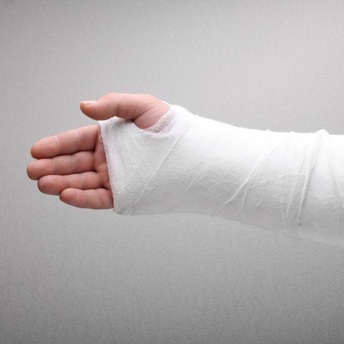 broken arm bone in cast