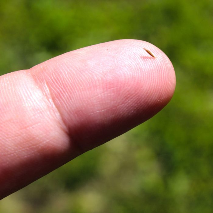 A splinter in the finger close-up.