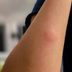 How to Get Rid of Itchy Mosquito Bites